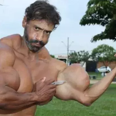 Valdir, der mit Synthol aufgeblasene, brasilianische "Bodybuilder", muss nun mit den Folgen seines Syntholmissbrauchs kämpfen! Echt abartig!
