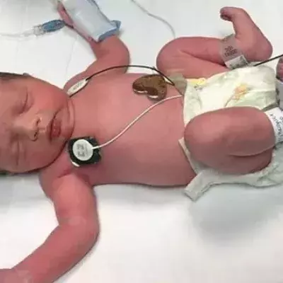 Lynlee Boemer kam zweimal zur Welt... Sie ist ein medizinisches Wunder!