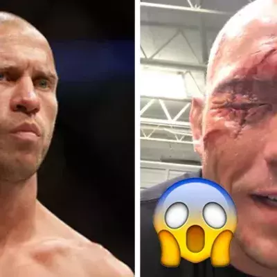 Donald „Cowboy“ Cerrone zeigt seine schreckliche Augenverletzung: Fake oder nicht?