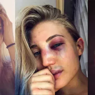 Anastasia Yankova zeigt ihr vom Kampf ramponiertes Gesicht