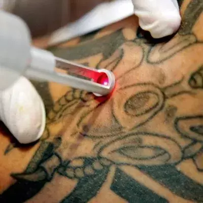 Tattoo-Entfernung per Laser