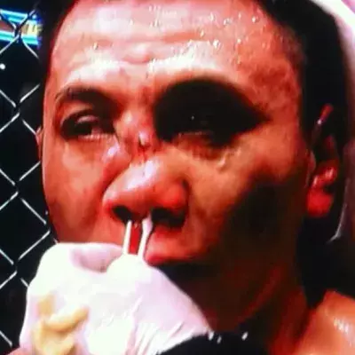 Das tut richtig weh: Die übelsten MMA-Verletzungen aller Zeiten!