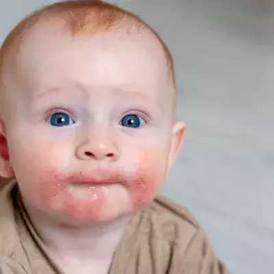 Atopische Dermatitis – Symptome, Ursachen, Therapie