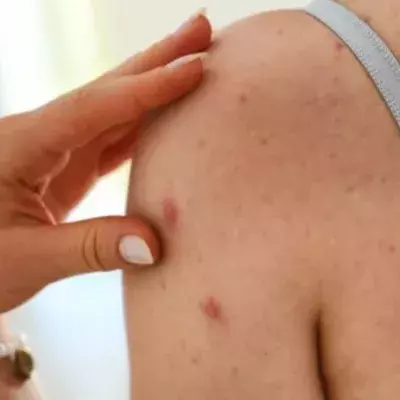 Uni Dresden warnt: Studentin könnte Epidemie ausgelöst haben