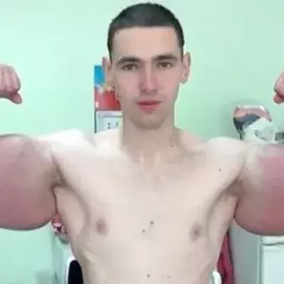 Russe spritzt sich Synthol in die Arme: Jetzt werden die Nebenwirkungen sichtbar