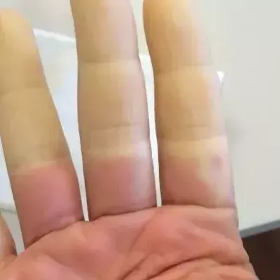 Raynaud-Syndrom: Symptome, Behandlung und Therapie