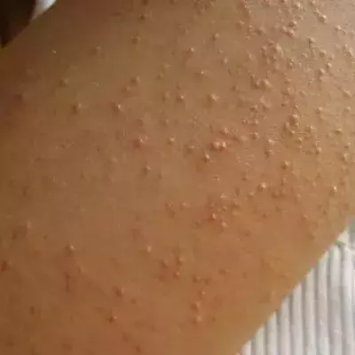 Glutenunverträglichkeit und ihre Symptome
