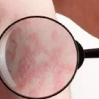 Schuppenflechte (Psoriasis): auf der Kopfhaut/Hand, Behandlung, Ernährung, Hausmittel und Symptome