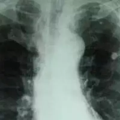 Was ist Tuberkulose? Symptome, Impfung, Test, Ansteckung, Lungentubakulose/Knochentubakulose, Behandlung