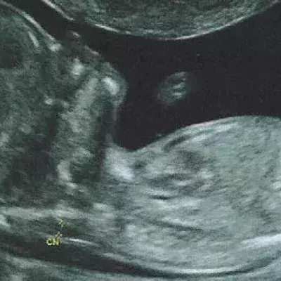 Down-Syndrom (Trisomie 21): Baby, Ursachen, Merkmale, Symptome, Lebenserwartung und Förderung