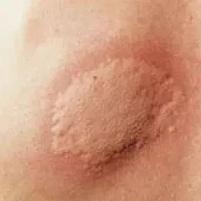 Nesselsucht: ist sie ansteckend? Behandlung, Hausmittel, Ursachen, Symptome und Dauer