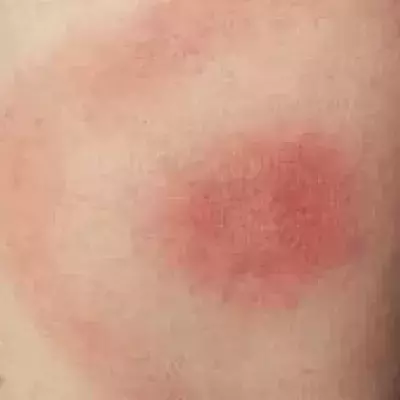 Lyme Borreliose: Symptome, Diagnose, Therapie, Behandlung, Erreger, was ist das überhaupt?
