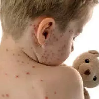 Masern: Symptome, Impfung, Inkubationszeit, Ansteckung, Erreger und Behandlung