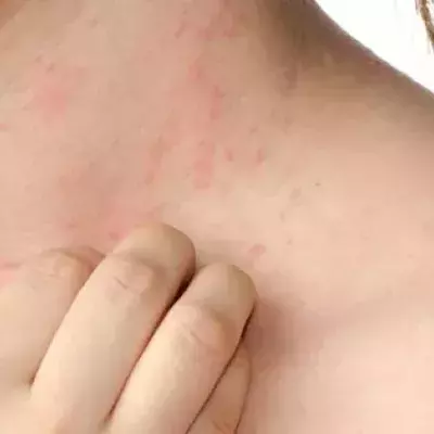 Ekzem: Die Formen Seborrhoisches Ekzem, Atopisches Ekzem, Konktaktekzem. Behandlung, Ursachen und Symtome