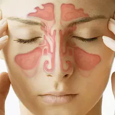 Sinusitis: Definition, Ethmoidalis/ Maxillaris/ Frontalis, Symptome, Hausmittel, Behandlung