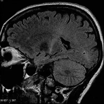 ALS Krankheit: Symptome, Lebenserwartung, Diagnose, Ursachen, was ist das?