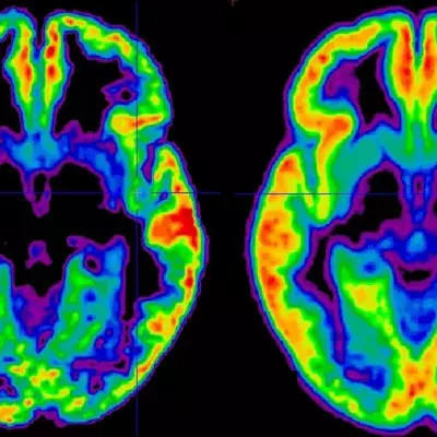 Schizophrenie: Definition, Symptome, Ursachen, Behandlung