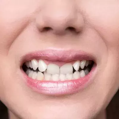 Schiefe Zähne: So wirken sie sich auf deine Gesundheit aus