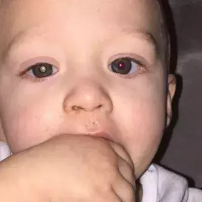 Der kleine Jaxson leidet an Augenkrebs