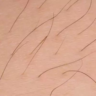 Eingewachsenes Haar wird zum Albtraum