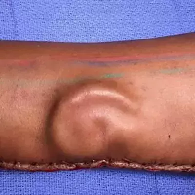 Sie pflanzen Ohr in den Arm ein