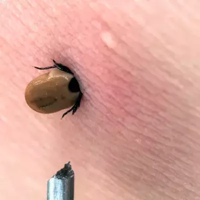 Zeckenbiss: Was tun?