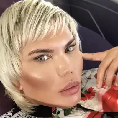 Rodrigo Alves kämpft jetzt mit den Folgen seiner 11 Nasen-OPs