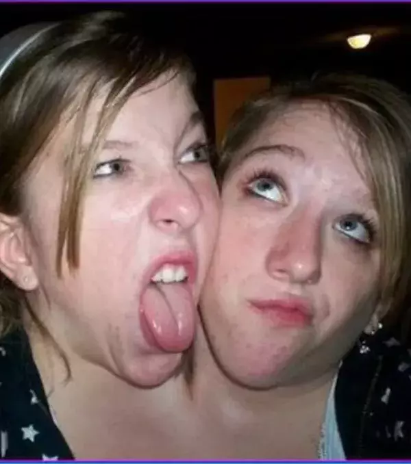 Abby und Brittany Hensel: Die Eltern von den beiden entschieden sich gegen eine Operation bei der sie hätten getrennt werden sollen, weil sie nicht genug Überlebenschancen hatten