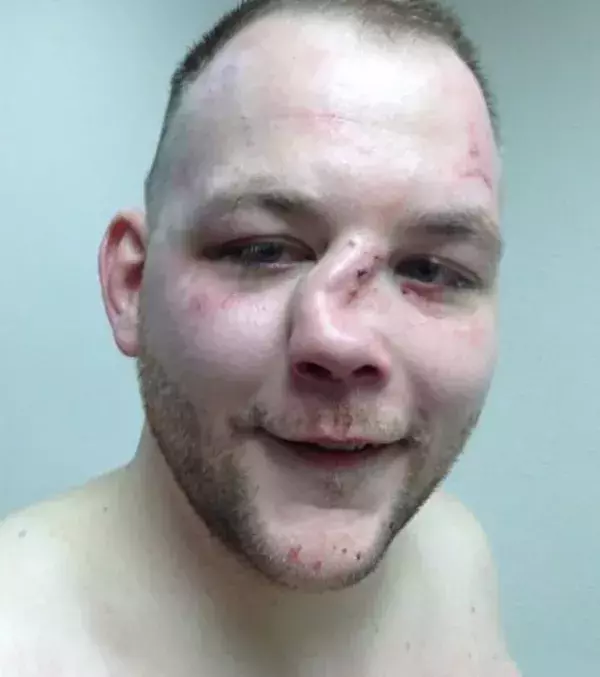 Andy Ice Cold Eichholz' Nase ist am 4. Januar 2014 nach ein paar Fausschlägen von Wade Sauer gebrochen