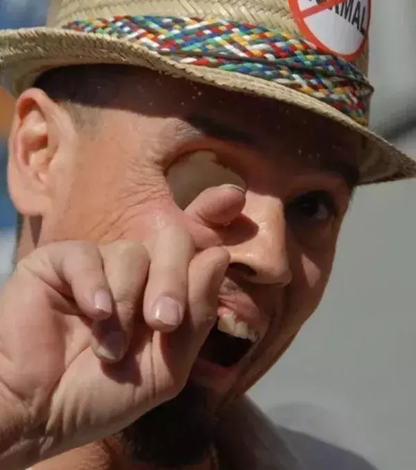Dieser Mann war an Krebs erkrankt. Er hat sein rechtes Auge verloren.