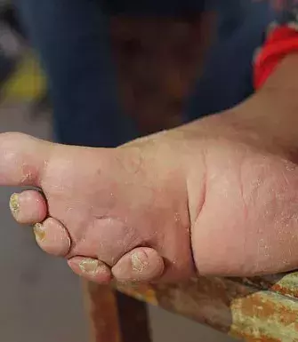 Dieser Fuß gehört einer 95-Jährigen Chinesin. Sie ist Opfer des Brauchs der abgeschnürten Füße. Mädchen werden die Füße abgebunden, damit die Zehen die runde Form des Lotus annehmen