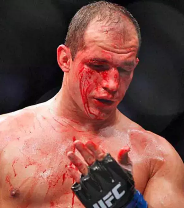 Junior Dos Santos Nase nach einigen Fausthieben im Dezember 2012 bei der UFC 155