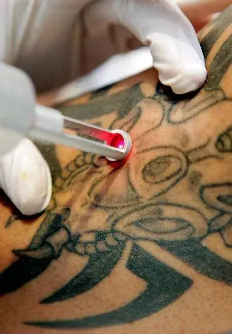 Laser-Einsatz zur Tattoo-Entfernung