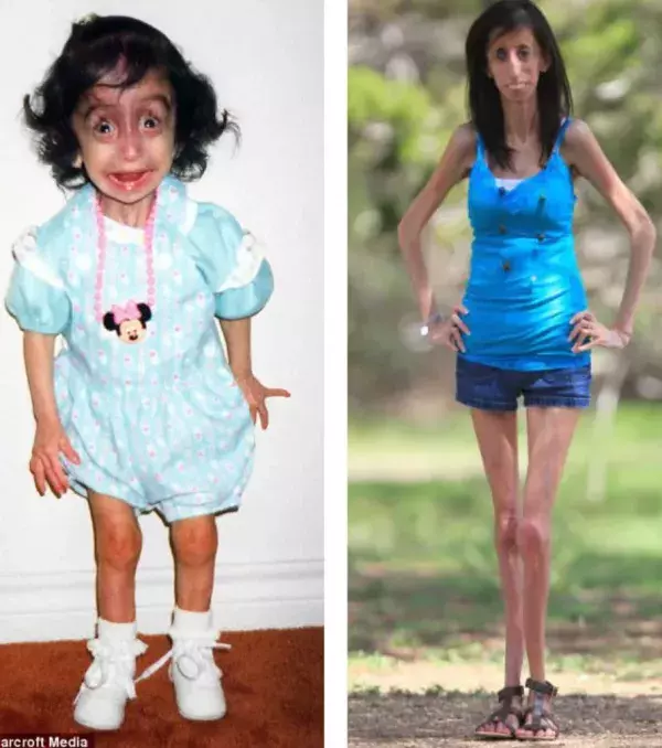 Lizzie Velasquez, die hässlichste Frau der Welt genannt wird, hat alle Prognosen der Ärzte bezüglich ihrer Lebenserwartung übertroffen