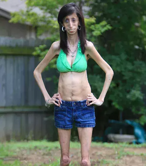 Lizzie Velasquez, die hässlichste Frau der Welt genannt wird, mit einem Bikinioberteil und Shorts