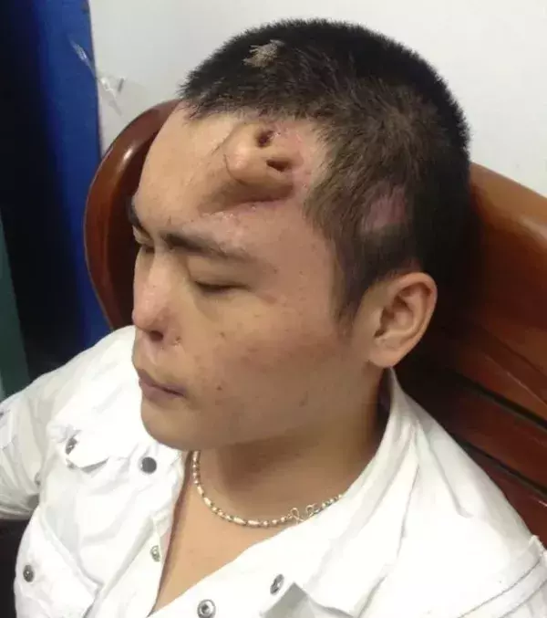 Nach einem Verkehrsunfall hat Xiao Lian seine Nase verloren. Mitten auf der Stirn dieses jungen Chinesen wächst eine neue Nase.