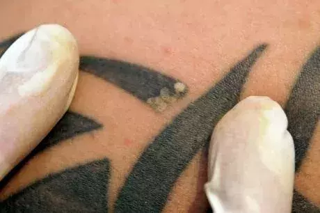 Tattoo-Entfernung: Nachher