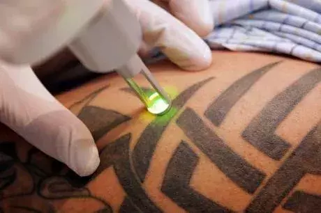 Tattoo-Entfernung: Vorher
