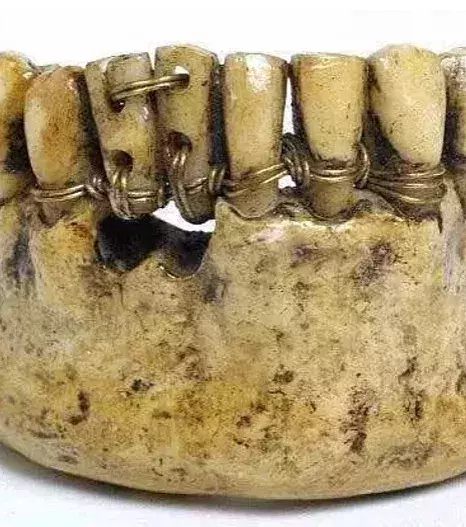 Zahnprothese aus dem antiken Rom