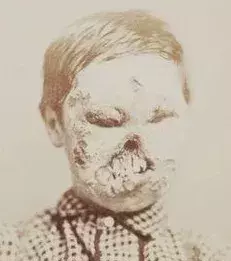 Zombies - Während der italienischen Renaissance deformierte eine Syphilis-Epidemie die Körper zahlreicher Menschen. Die Symptome lassen uns an Monster glauben…