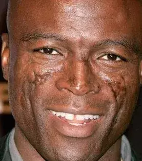 Da er an der seltenen Krankheit Lupus Erythemateux erkankte, hat der Sänger Seal markante Narben im Gesicht